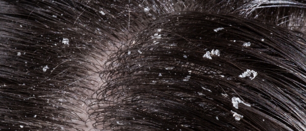 Dandruff Problem | Miracle Hair Expert